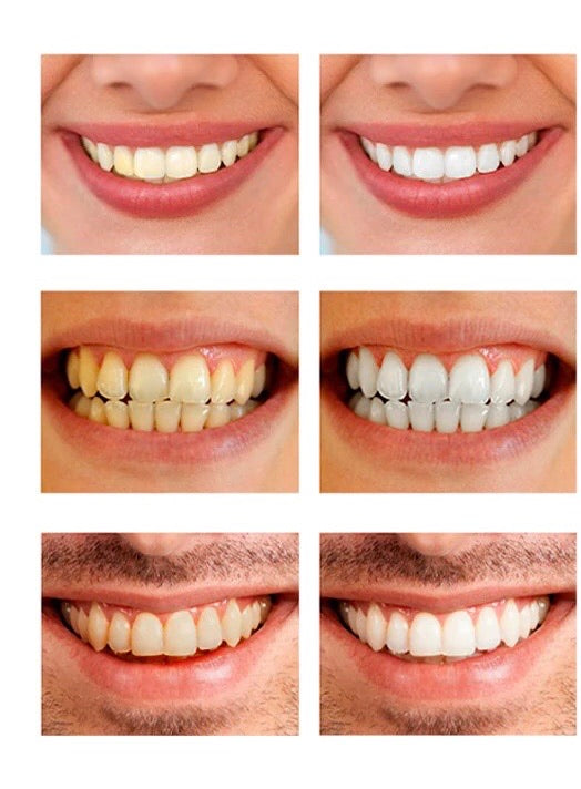 Chiqlabel effective teeth whitening mousse